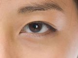 2mm Asian double eyelid with mild inside epicanthal fold; Asian double eyelid surgery, DST method, natural
